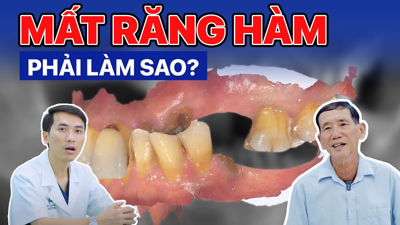Mất Răng Hàm Phải Làm Sao? Review Thực Tế Từ Khách Hàng Mất Nhiều Răng Hàm