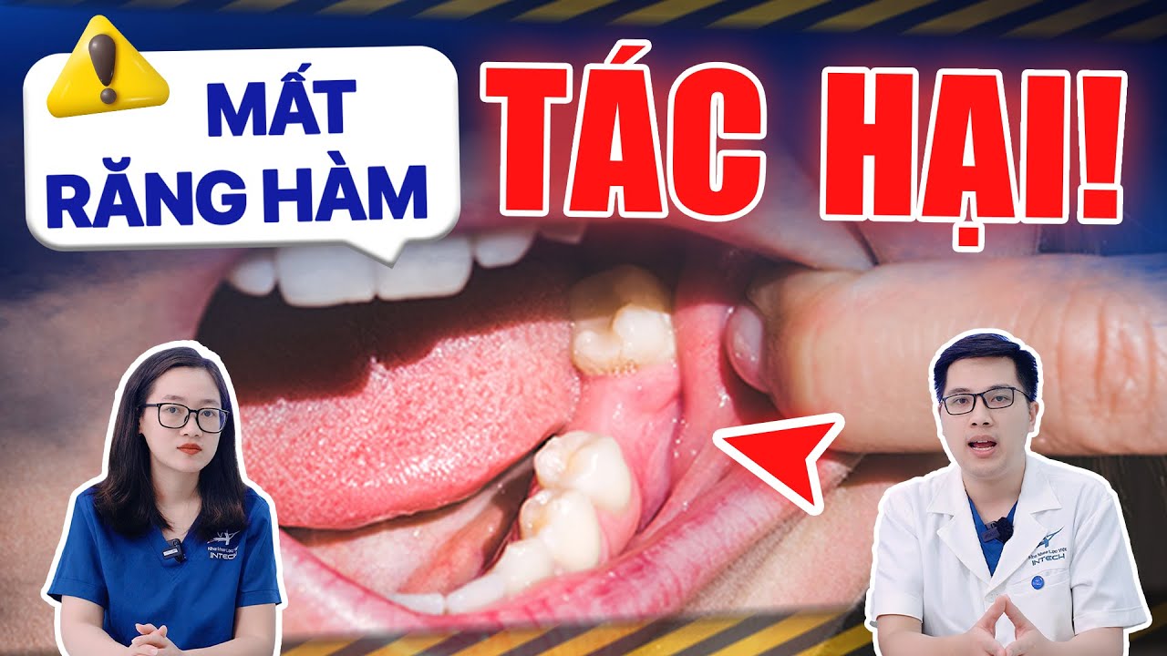 Tác Hại Của Việc Mất Răng Hàm: 5 Sự Thật Kinh Hoàng đừng Xem Nhẹ và cách khắc phục
