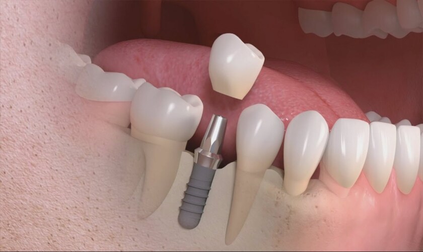 Trồng răng khi mất răng số 6