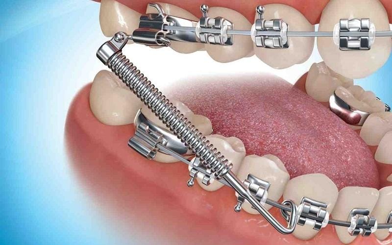 Mất răng số 6 có niềng được không?