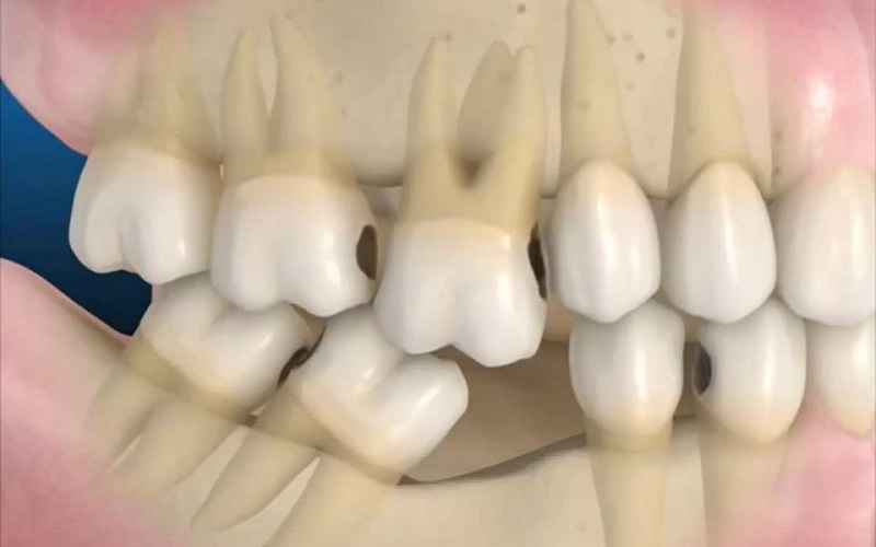 Mất răng số 6