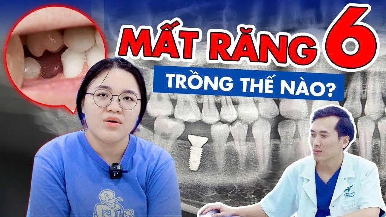 Mất Răng Số 6 Suốt 10 Năm, Trồng Lại Thế Nào? Có Đau Không?