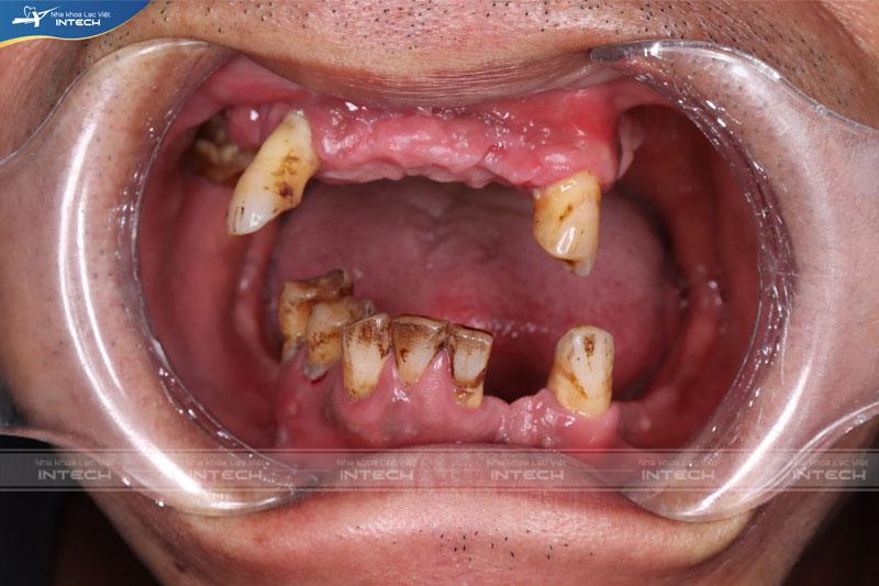 Tình trạng mất răng toàn hàm xảy ra do nhiều nguyên nhân khác nhau