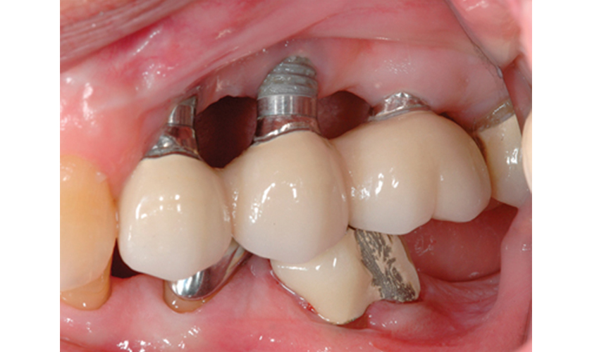 Kỹ thuật không chuẩn xác có thể làm mất tích hợp implant