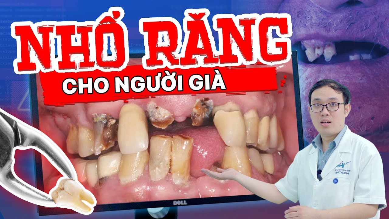 Răng Lung Lay Có Nên Nhổ Không? 5 Trường Hợp Bắt Buộc Phải Can Thiệp Nhổ Răng Ở Người Già