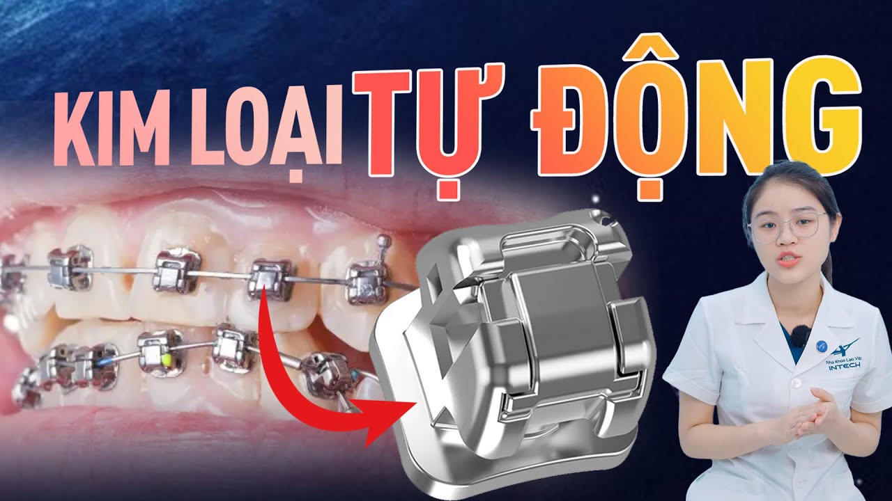 Mắc cài kim loại tự động có tốt không? 4 lý do bạn nên chọn 
