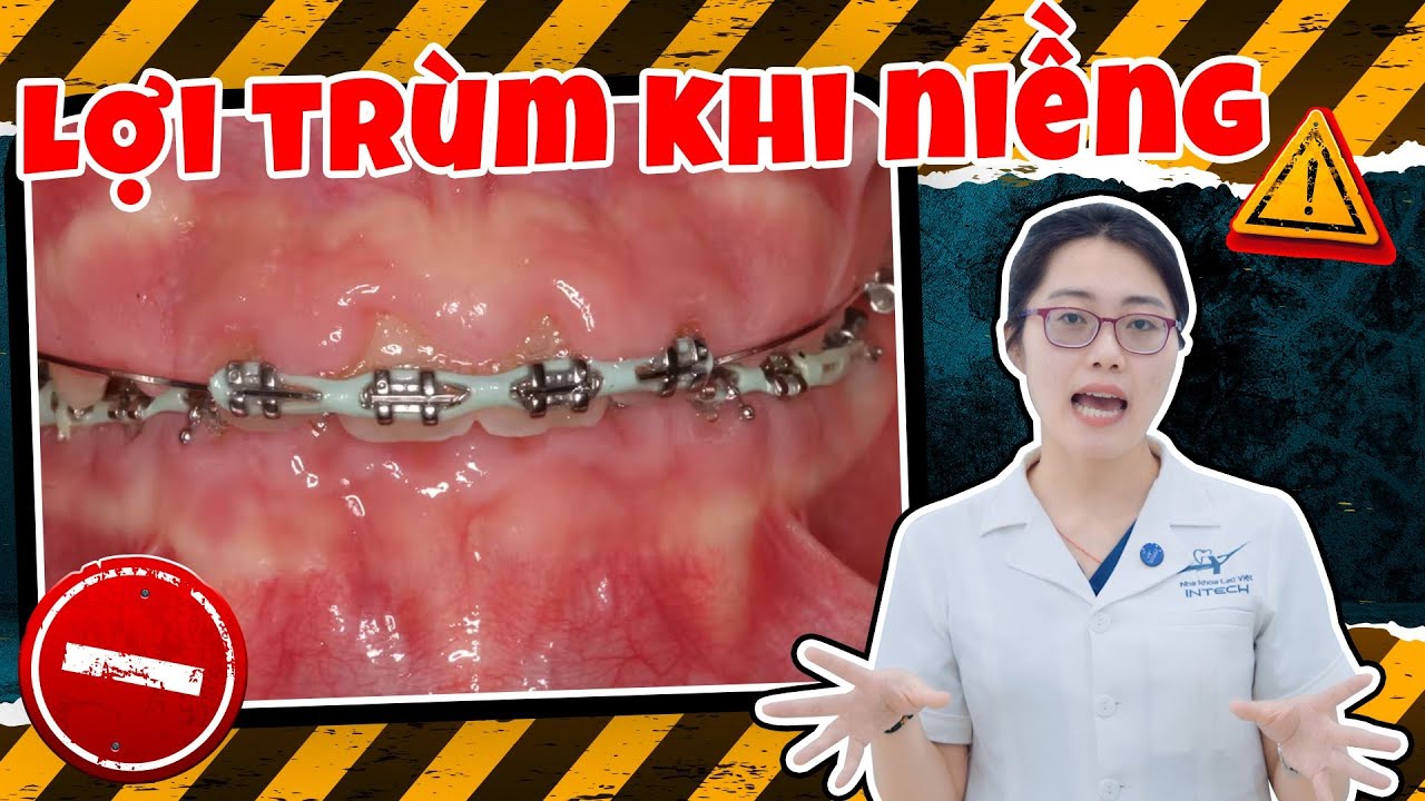 Lợi Trùm Khi Niềng Răng - 3 Dấu Hiệu Cần Biết