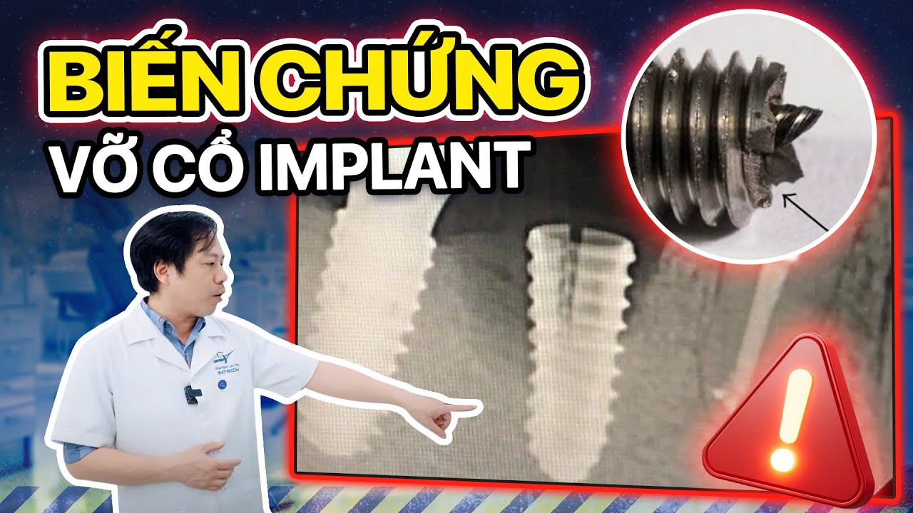 Biến chứng vỡ cổ implant gây ra nguy cơ nghiêm trọng cho sức khỏe răng miệng