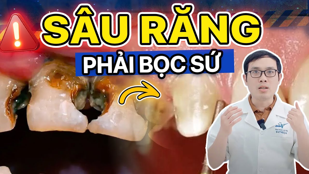 Bọc Sứ Răng Sâu: Có Thực Sự Cần Hay Chỉ Tốn Tiền? 3 Trường Hợp Không Nên Bọc Sứ!