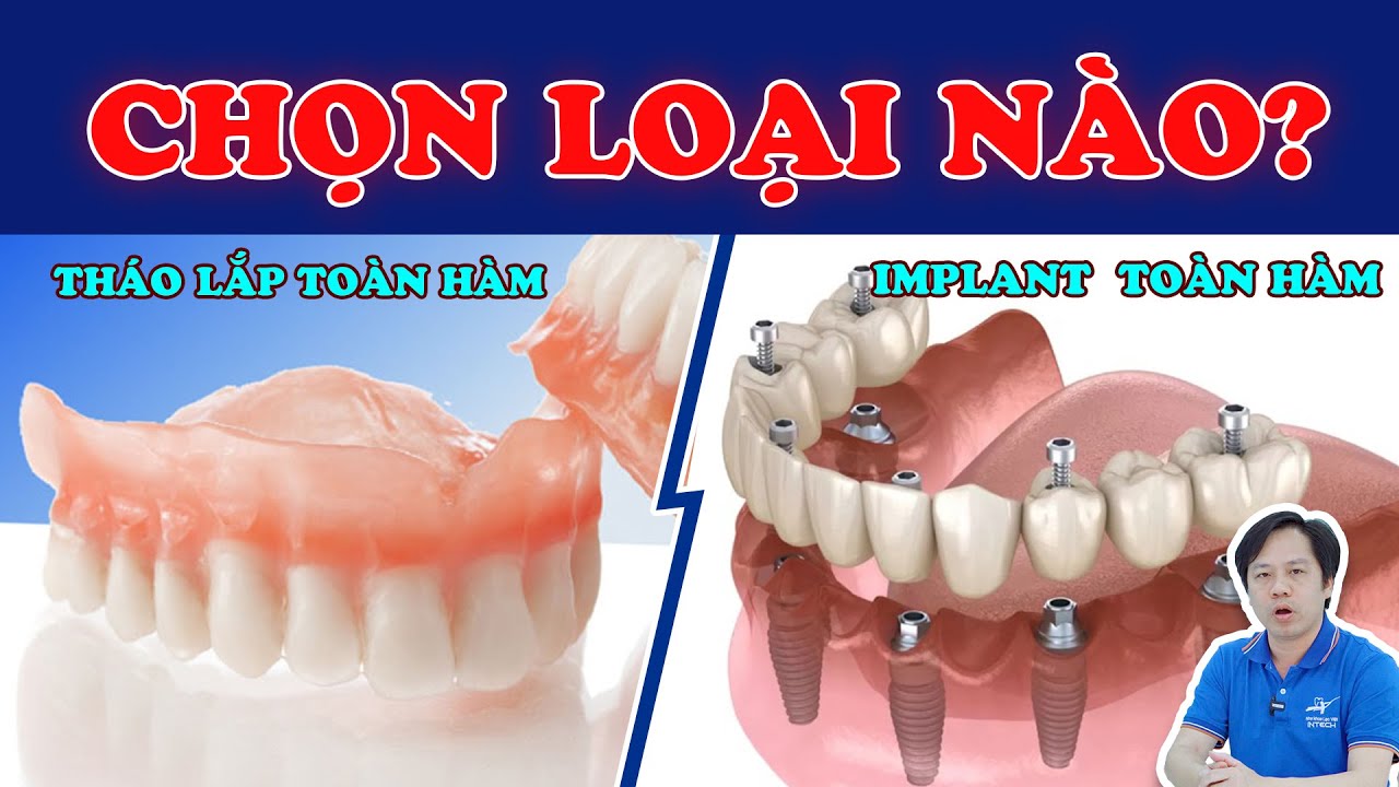 3 phương pháp trồng răng toàn hàm: Giá chênh nhau tới vài chục triệu, khác biệt nằm ở đâu?