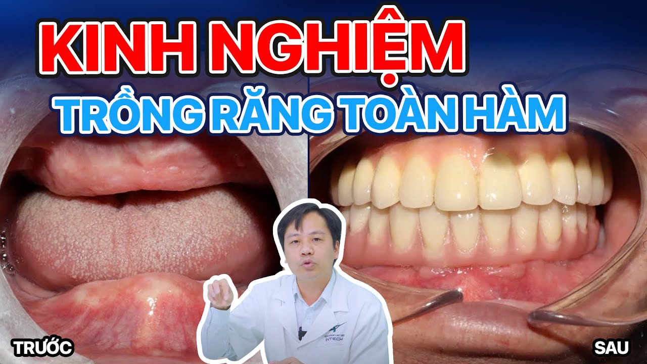 5 Kinh Nghiệm Trồng Răng Implant Toàn Hàm.Nắm Vững Để Trồng Răng An Toàn