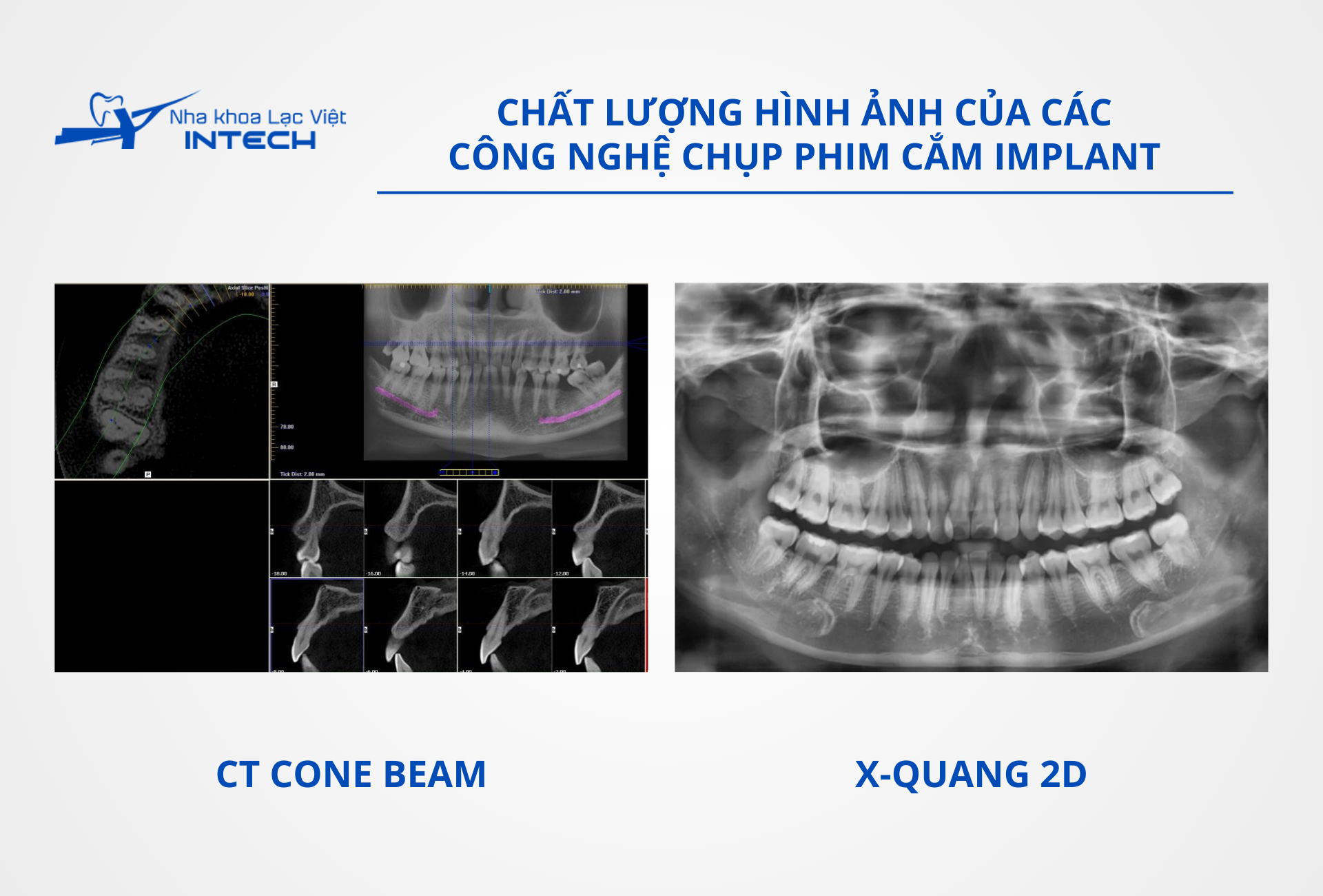 Máy CT Cone Beam cho chất lượng hình ảnh sắc nét, đa chiều hơn X-quang 2D truyền thống với khả năng tầm soát xương chi tiết hơn để sử dụng cho trồng răng Implant