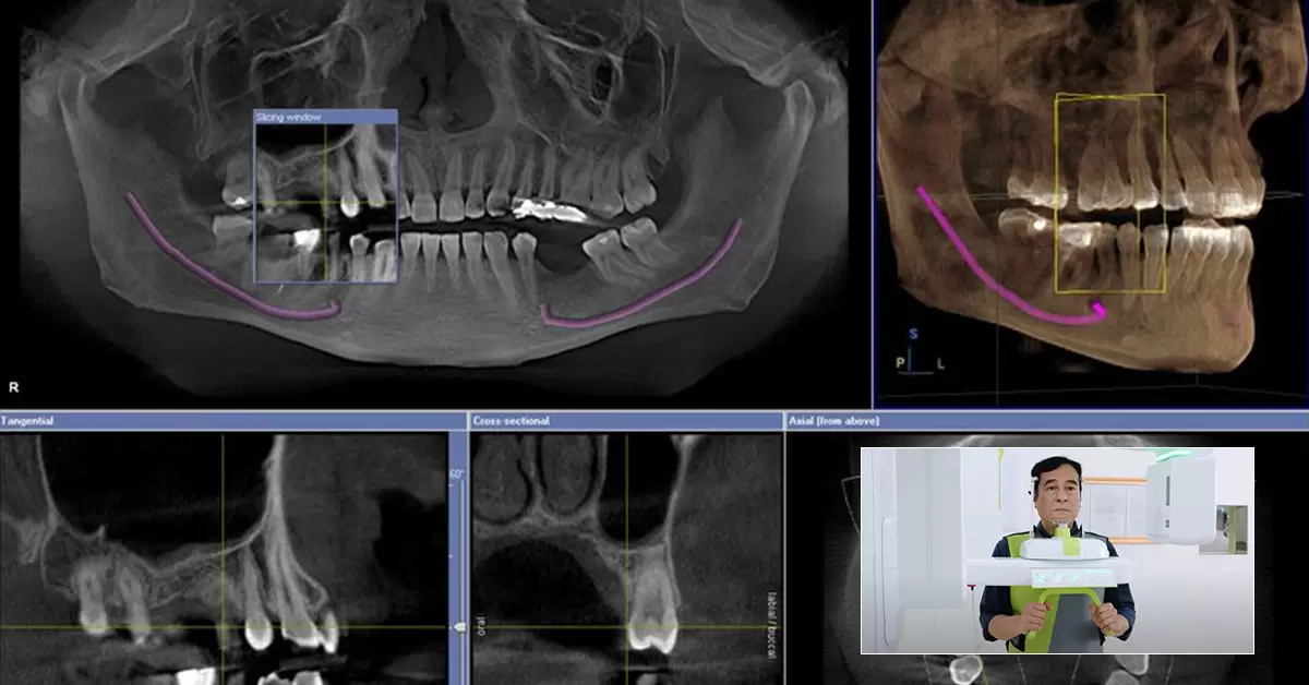 Máy CT Cone Beam cho phép chụp ảnh xương hàm đa chiều, tạo thành khối 3D chi tiết giúp bác sĩ dễ dàng phát hiện các bất thường nhỏ của răng miệng