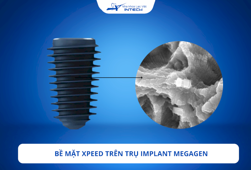 Trụ áp dụng công nghệ xử lý bề mặt XPEED mang đến sự sinh xương vượt trội và thời gian tích hợp nhanh chóng
