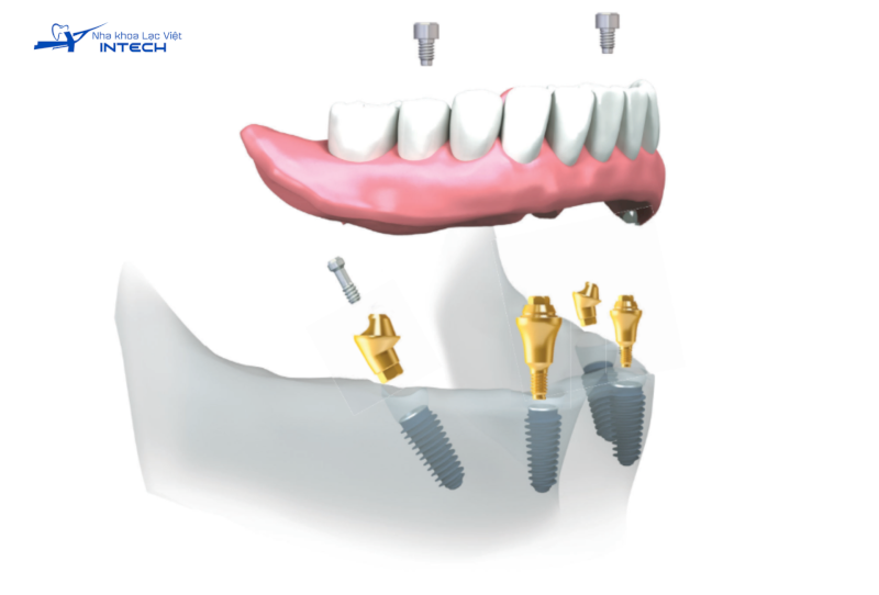 Trụ Implant Megagen Hàn Quốc có mức giá cao, cô chú/anh chị nên cân nhắc trước khi lựa chọn