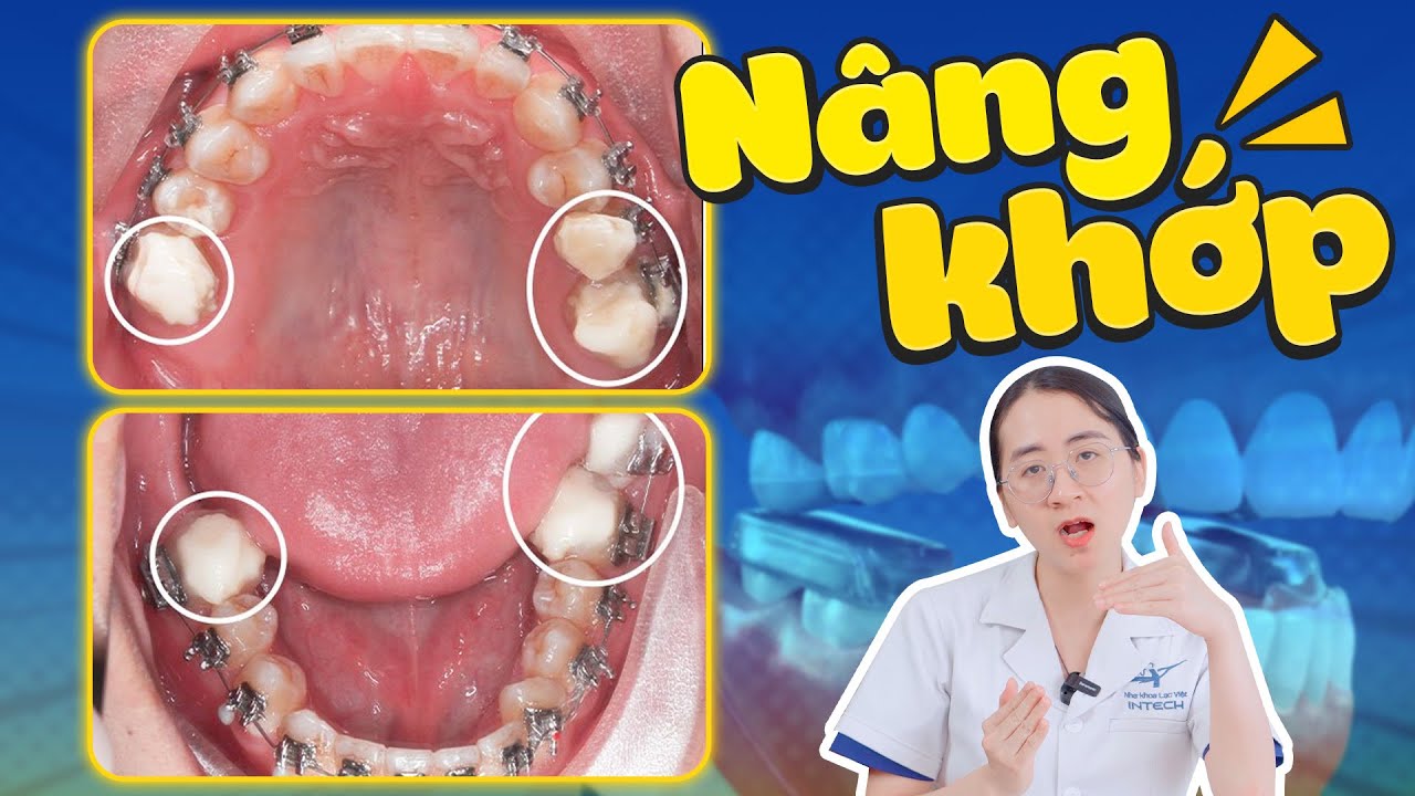 Nâng khớp cắn trong niềng răng - Vì sao 70% khách hàng "bắt buộc" phải nâng khớp?