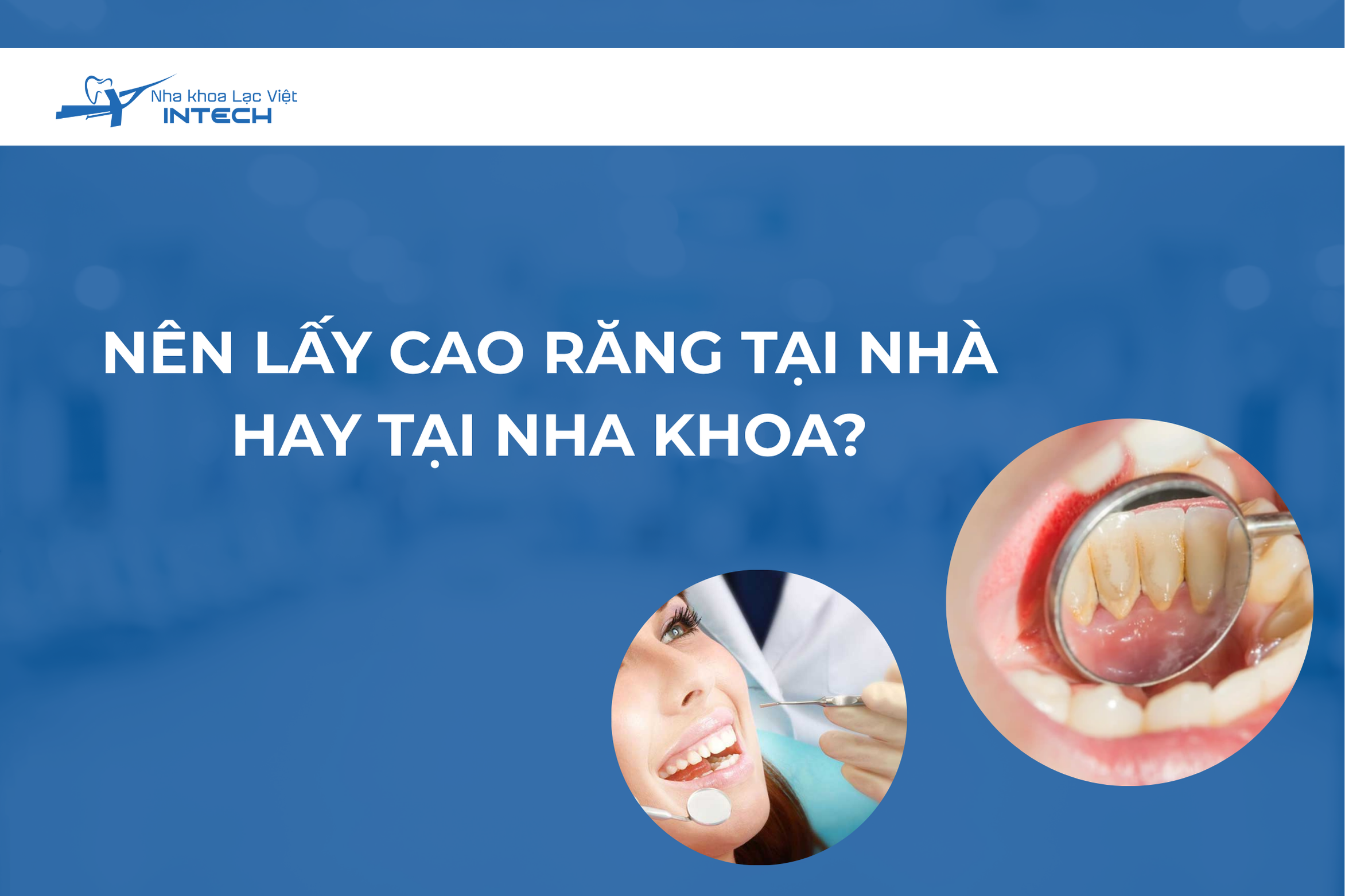 Nên lấy cao răng tại nhà hay tại nha khoa? Quy trình ra sao?