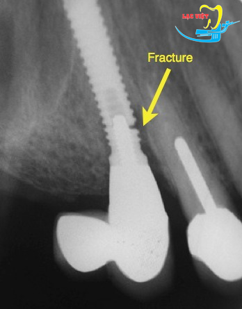 Răng implant bị lung lay do gãy implant