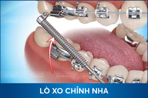 Gắn lò xo khi niềng răng có tác dụng gì? Có mấy loại lò xo?