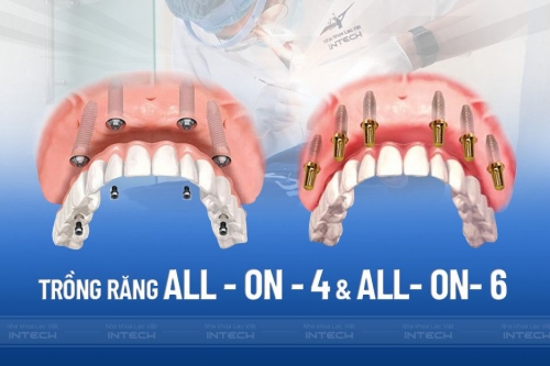 Trồng răng Implant nguyên hàm All On 4, All On 6 an toàn