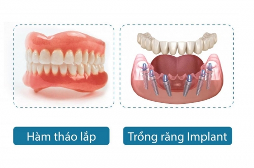 Trồng răng Implant toàn hàm phương pháp All on 4, All on 6