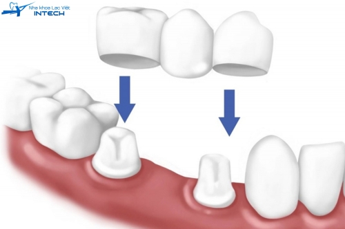 3 phương pháp trồng răng giả phổ biến hiện nay