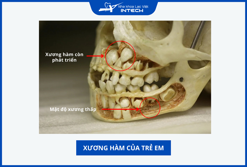 Người dưới 18 tuổi thường chưa đủ mật độ xương hàm để thực hiện cấy ghép Implant