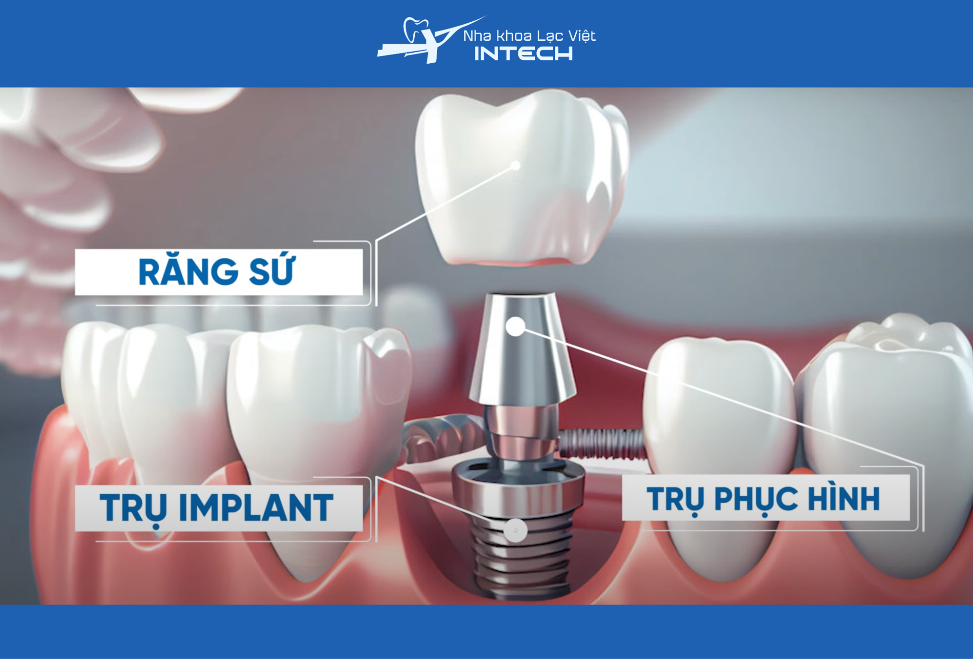 Người trồng răng cần trang bị kiến thức đúng đắn về răng Implant, đồng thời nâng cao cảnh giác trước những quảng cáo sai sự thật trên mạng