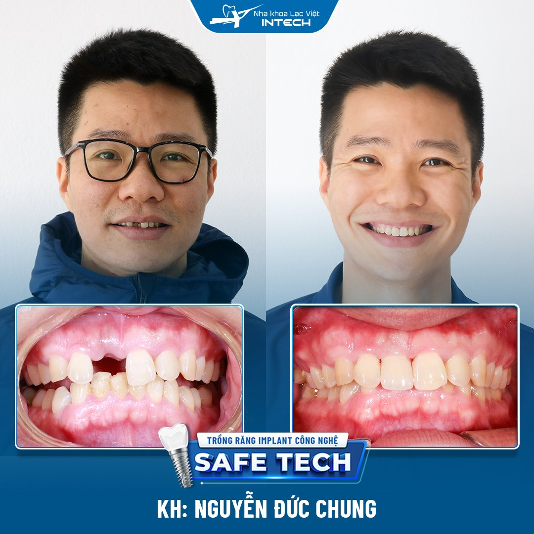 Anh Nguyễn Đức Chung trồng răng cửa hàm trên tại Nha khoa Lạc Việt Intech