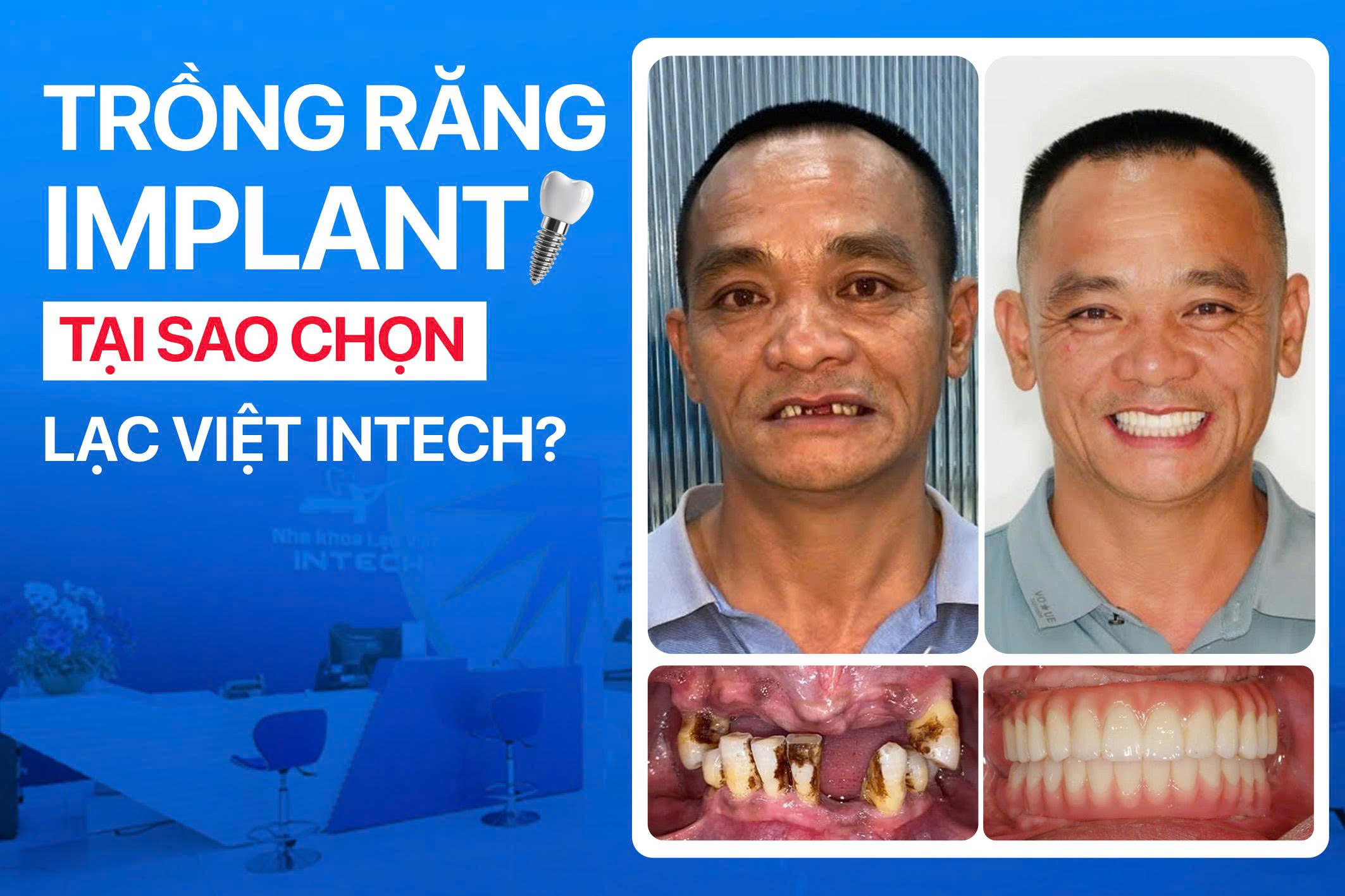 Nha khoa trồng răng implant tốt nhất: Vì sao nhiều bệnh nhân chọn Lạc Việt Intech để cấy ghép Implant?