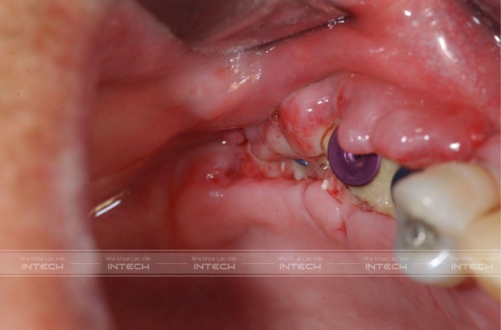 Nhiễm trùng sau khi cấy ghép Implant