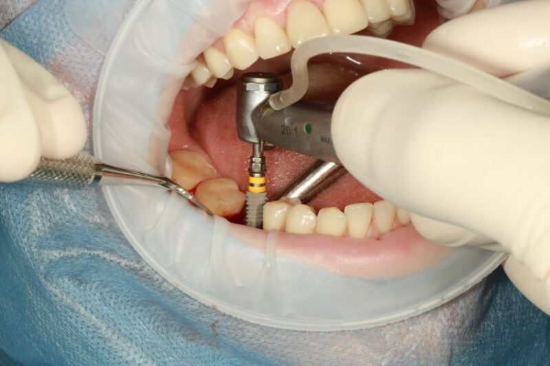 Cấy răng Implant không áp dụng công nghệ cao, thực hiện bởi bác sĩ tay nghề yếu và trụ Implant kém chất lượng dễ gây viêm nhiễm