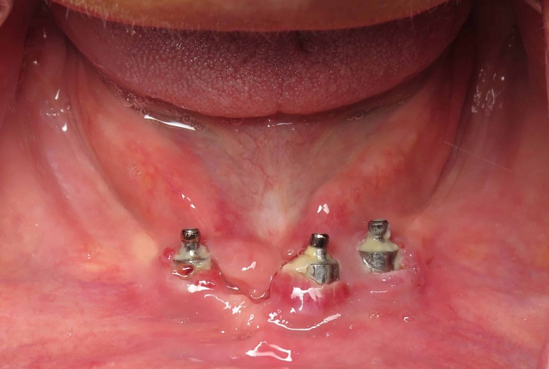 6 dấu hiệu cảnh báo nhiễm trùng Implant: Nguyên nhân & cách xử lý