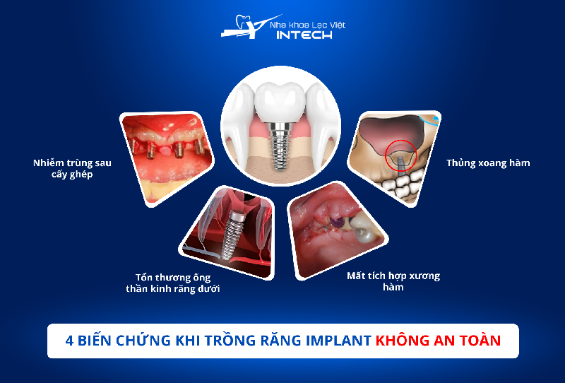 Nếu không đảm bảo an toàn trong quy trình cấy ghép Implant, cô chú/anh chị có thể gặp nhiều biến chứng nguy hiểm