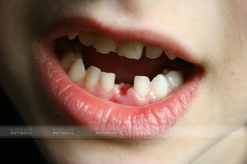 Có rất nhiều nguyên nhân gây mất răng ở trẻ