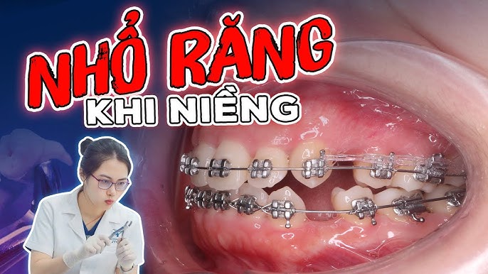 Nhổ răng khi niềng: Có thật sự cần thiết và nguy hiểm như lời đồn?