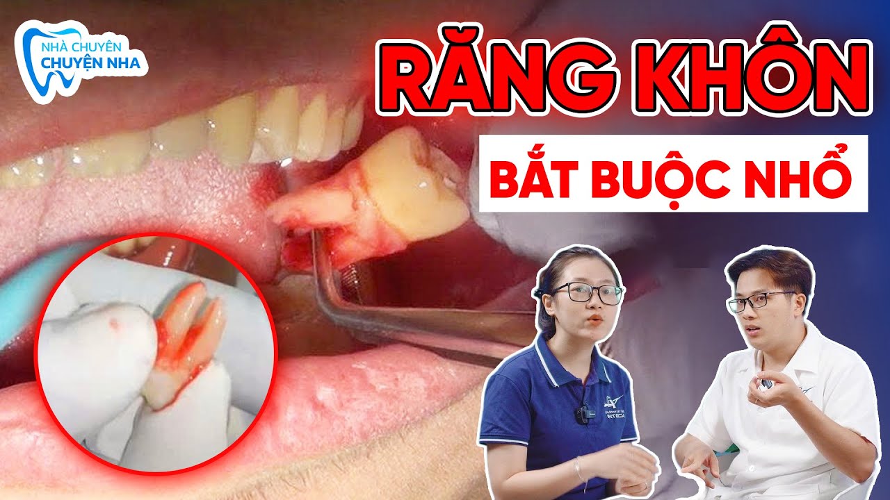 Nhổ Răng Khôn Có Bắt Buộc Không? Sự Thật Không Phải Bác Sĩ Nào Cũng Tiết Lộ!