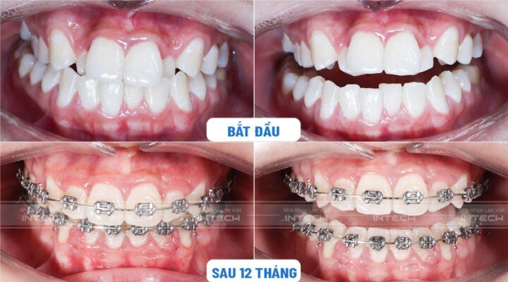 niềng răng khấp khểnh 