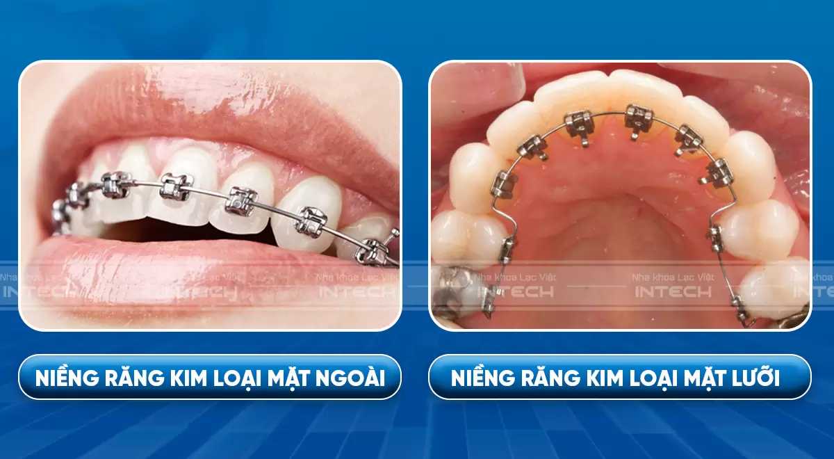 niềng răng mắc cài 