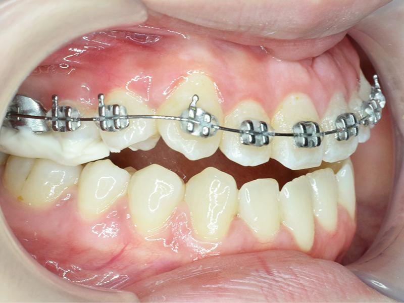 Niềng răng 1 hàm có đuọc không  