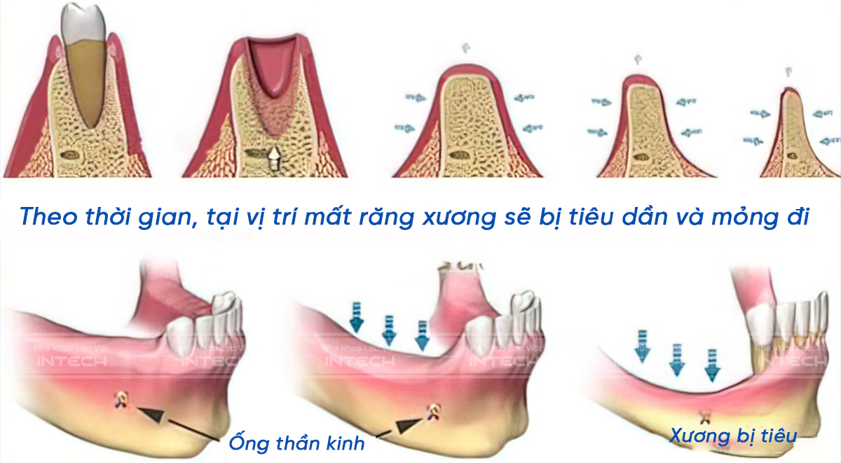 Mất răng lâu ngày và tiêu xương ổ răng có thể gây hóp má