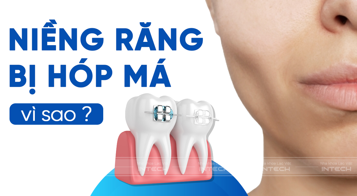 Niềng răng bị hóp má 