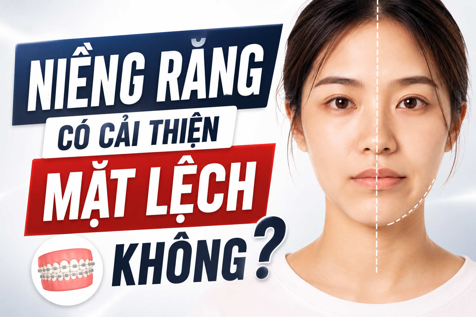 Hình ảnh thực tế: Niềng răng có cải thiện mặt lệch không? 