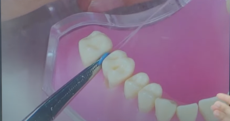 niềng răng có đau không