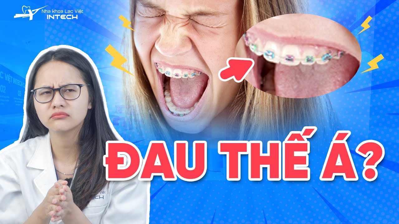 Làm sao để niềng răng không bị đau, niềng răng có đau không chuyên gia chia sẻ