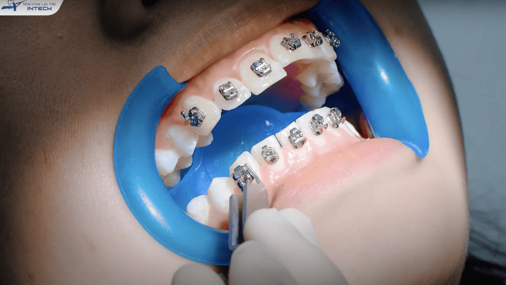 Niềng răng có thực sự đau không?