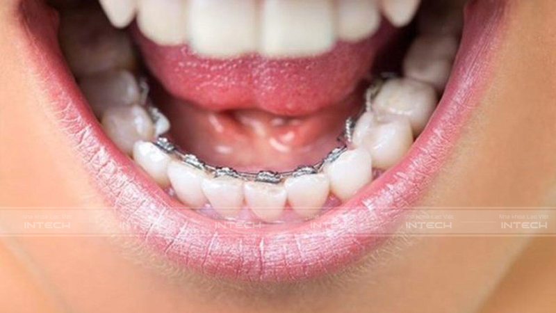niềng răng hàm dưới giá bao nhiêu