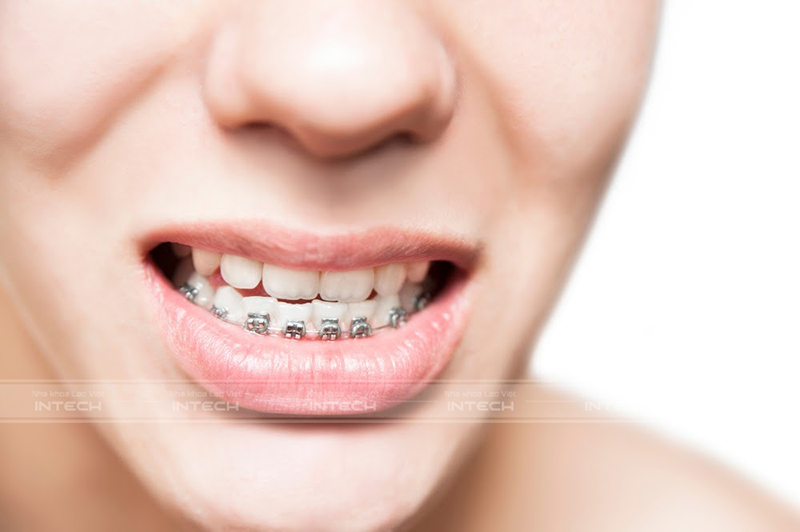 niềng răng hàm dưới mất bao lâu