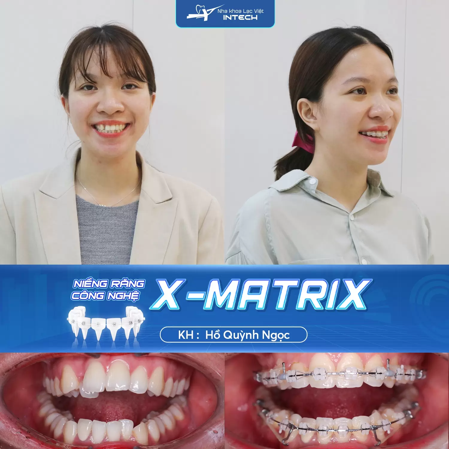 Niềng răng mắc cài sứ tự động 