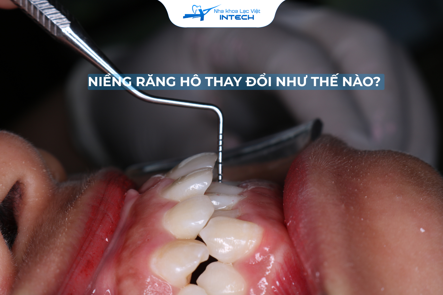 NIỂNG RĂNG HÔ THAY ĐỔI NHƯ THẾ NÀO? NHỮNG ĐIỀU CẦN BIẾT KHI NIỀNG RĂNG HÔ